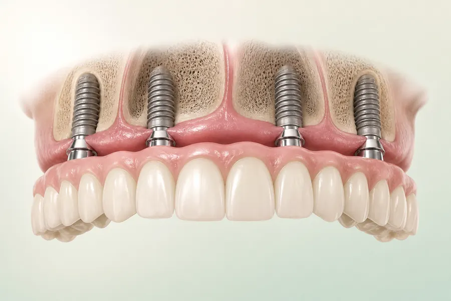 Denti fissi in Croazia: ponte dentale sostenuto da quattro impianti