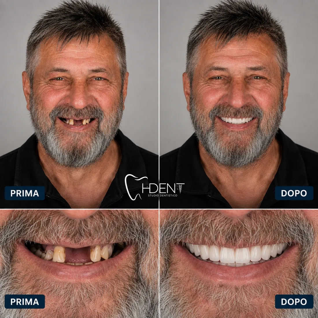 Denti in Croazia prima e dopo una riabilitazione completa H-Dent